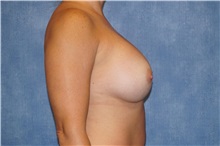 Breast Augmentation After Photo by George John Alexander, MD, FACS; ,  - Case 32340