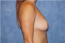 Breast Augmentation Before Photo by George John Alexander, MD, FACS; ,  - Case 32340