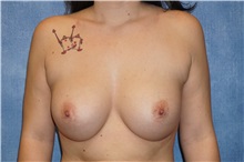Breast Augmentation After Photo by George John Alexander, MD, FACS; ,  - Case 32341