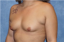 Breast Augmentation Before Photo by George John Alexander, MD, FACS; ,  - Case 32341