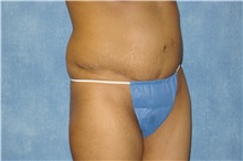 Tummy Tuck After Photo by George John Alexander, MD, FACS; ,  - Case 32343