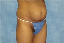 Tummy Tuck Before Photo by George John Alexander, MD, FACS; ,  - Case 32343