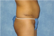 Tummy Tuck After Photo by George John Alexander, MD, FACS; ,  - Case 32343