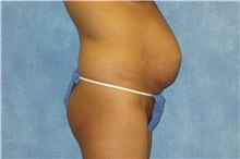 Tummy Tuck Before Photo by George John Alexander, MD, FACS; ,  - Case 32343