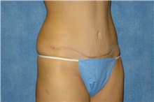 Tummy Tuck After Photo by George John Alexander, MD, FACS; ,  - Case 32344