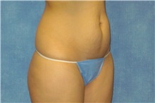 Tummy Tuck Before Photo by George John Alexander, MD, FACS; ,  - Case 32344