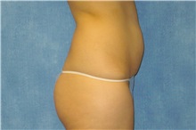 Tummy Tuck Before Photo by George John Alexander, MD, FACS; ,  - Case 32344
