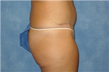 Tummy Tuck After Photo by George John Alexander, MD, FACS; ,  - Case 32347