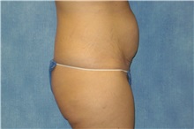 Tummy Tuck Before Photo by George John Alexander, MD, FACS; ,  - Case 32347