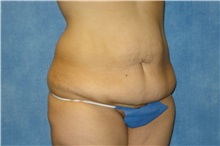 Tummy Tuck Before Photo by George John Alexander, MD, FACS; ,  - Case 32348