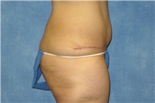 Tummy Tuck After Photo by George John Alexander, MD, FACS; ,  - Case 32348