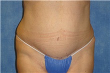 Tummy Tuck After Photo by George John Alexander, MD, FACS; Las Vegas, NV - Case 32349