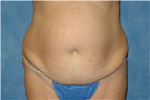 Tummy Tuck Before Photo by George John Alexander, MD, FACS; Las Vegas, NV - Case 32349