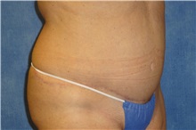 Tummy Tuck After Photo by George John Alexander, MD, FACS; ,  - Case 32349