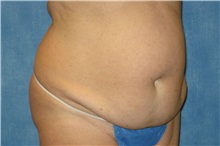 Tummy Tuck Before Photo by George John Alexander, MD, FACS; ,  - Case 32349