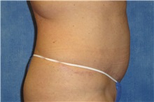Tummy Tuck After Photo by George John Alexander, MD, FACS; ,  - Case 32349