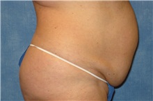 Tummy Tuck Before Photo by George John Alexander, MD, FACS; ,  - Case 32349