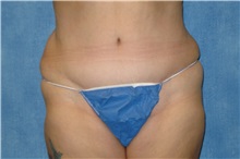 Tummy Tuck After Photo by George John Alexander, MD, FACS; Las Vegas, NV - Case 32607