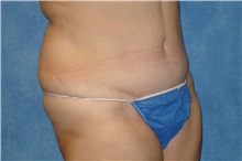 Tummy Tuck After Photo by George John Alexander, MD, FACS; ,  - Case 32607