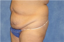 Tummy Tuck Before Photo by George John Alexander, MD, FACS; ,  - Case 32607