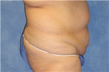 Tummy Tuck Before Photo by George John Alexander, MD, FACS; ,  - Case 32607