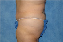 Tummy Tuck After Photo by George John Alexander, MD, FACS; ,  - Case 32607