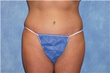 Tummy Tuck After Photo by George John Alexander, MD, FACS; ,  - Case 32609
