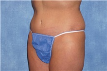 Tummy Tuck After Photo by George John Alexander, MD, FACS; ,  - Case 32609