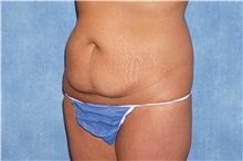 Tummy Tuck Before Photo by George John Alexander, MD, FACS; ,  - Case 32609