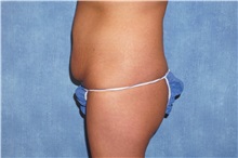 Tummy Tuck Before Photo by George John Alexander, MD, FACS; ,  - Case 32609