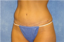 Tummy Tuck After Photo by George John Alexander, MD, FACS; ,  - Case 32637