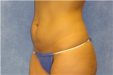 Tummy Tuck Before Photo by George John Alexander, MD, FACS; ,  - Case 32637