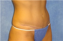 Tummy Tuck After Photo by George John Alexander, MD, FACS; ,  - Case 32637