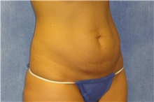 Tummy Tuck Before Photo by George John Alexander, MD, FACS; ,  - Case 32637