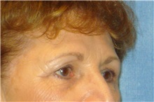 Brow Lift Before Photo by George John Alexander, MD, FACS; ,  - Case 32643