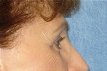 Brow Lift After Photo by George John Alexander, MD, FACS; ,  - Case 32643