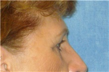 Brow Lift Before Photo by George John Alexander, MD, FACS; ,  - Case 32643
