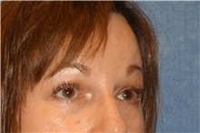 Brow Lift After Photo by George John Alexander, MD, FACS; ,  - Case 32647