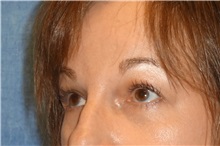 Brow Lift After Photo by George John Alexander, MD, FACS; ,  - Case 32647