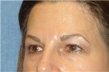 Brow Lift Before Photo by George John Alexander, MD, FACS; ,  - Case 32647