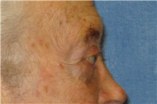 Eyelid Surgery After Photo by George John Alexander, MD, FACS; ,  - Case 32651