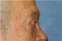 Eyelid Surgery Before Photo by George John Alexander, MD, FACS; ,  - Case 32651