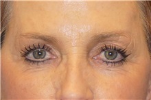 Brow Lift Before Photo by George John Alexander, MD, FACS; ,  - Case 32654