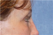 Brow Lift After Photo by George John Alexander, MD, FACS; ,  - Case 32654