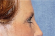 Brow Lift Before Photo by George John Alexander, MD, FACS; ,  - Case 32654