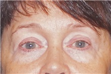 Eyelid Surgery After Photo by George John Alexander, MD, FACS; ,  - Case 32720