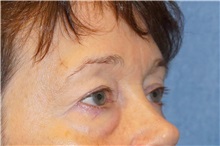 Eyelid Surgery Before Photo by George John Alexander, MD, FACS; ,  - Case 32720