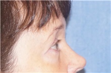 Eyelid Surgery After Photo by George John Alexander, MD, FACS; ,  - Case 32720