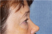 Eyelid Surgery Before Photo by George John Alexander, MD, FACS; ,  - Case 32720