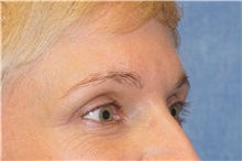 Eyelid Surgery After Photo by George John Alexander, MD, FACS; ,  - Case 32721